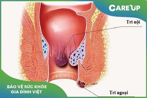 4 Điều biết trước khi sử dụng viên thuốc đặt trĩ