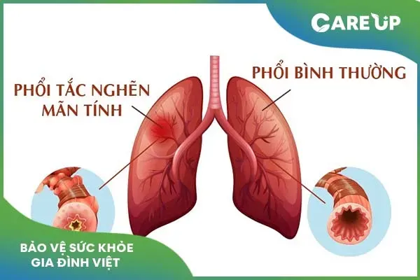 Acetylcystein – Liệu pháp cho bệnh phổi tắc nghẽn mạn tính