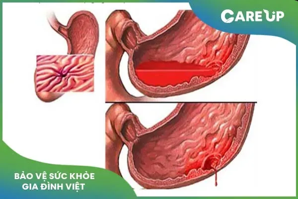 Aspirin: Tìm hiểu toàn diện về công dụng, liều dùng, tác dụng phụ