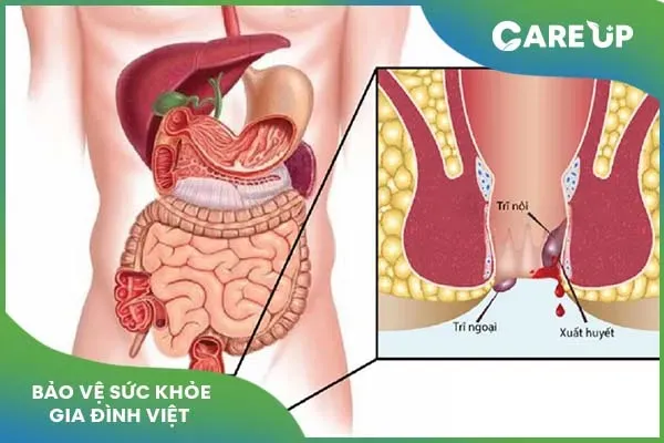 Hướng dẫn dùng thuốc chữa bệnh trĩ để hiệu quả cao