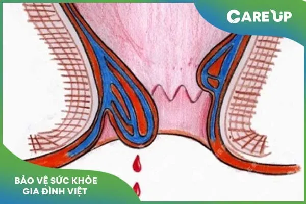 Lưu ý gì khi dùng Proctolog điều trị bệnh lý hậu môn?