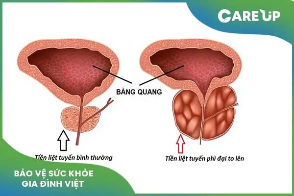 Lưu ý khi dùng thuốc đặc trị phì đại tiền liệt tuyến