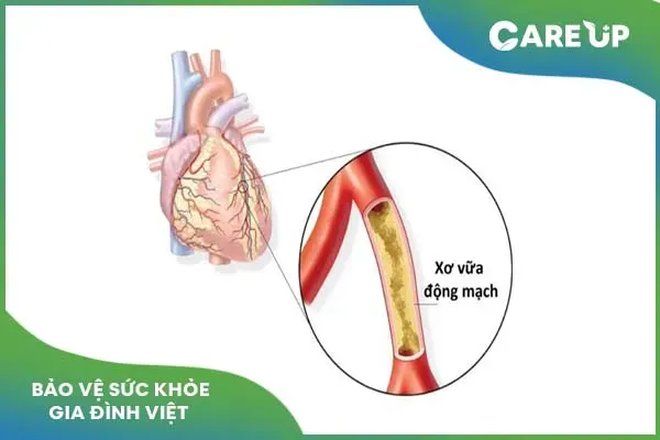 Ridlor 75mg điều trị bệnh lý gì, lưu ý ra sao khi sử dụng?