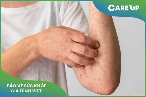 Thuốc Medrol 4mg: Cách sử dụng, tác dụng phụ và cách bảo quản