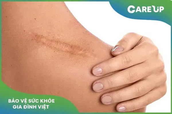 Thuốc trị sẹo Scar Esthetique: Công dụng và lưu ý sử dụng