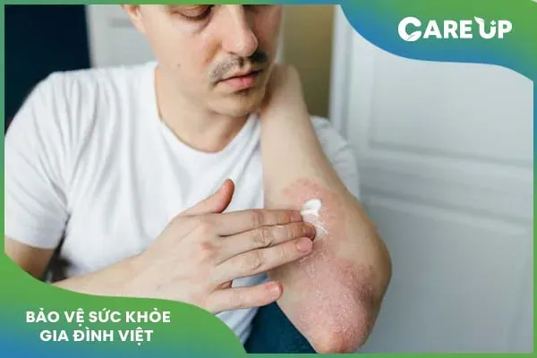 Triamcinolone: Thuốc chống viêm hiệu quả cho nhiều bệnh lý