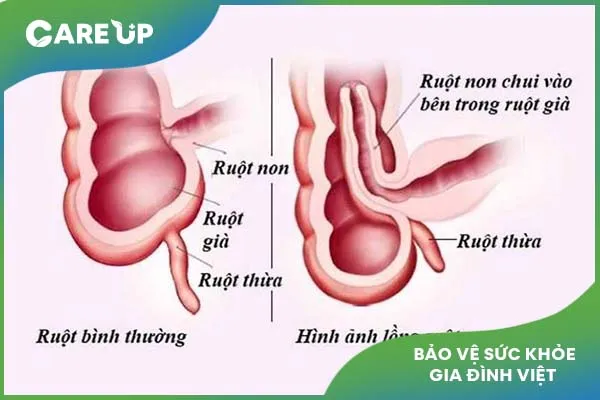 4 Dấu hiệu nhận biết sớm bệnh lồng ruột ở trẻ em