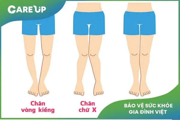 Bệnh còi xương ở tuổi thiếu niên: Tổng hợp thông tin