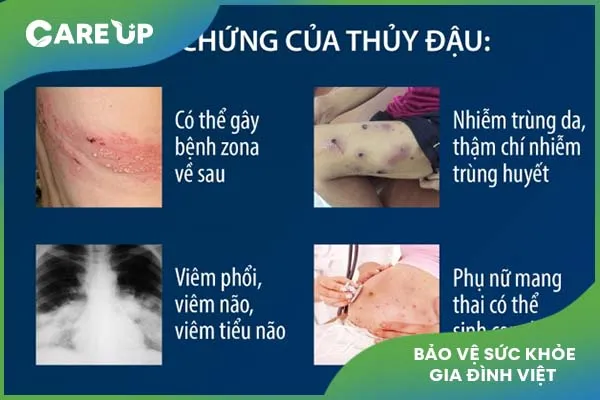  Bệnh thủy đậu lây lan nhanh, mẹ đã biết cách phòng cho bé?