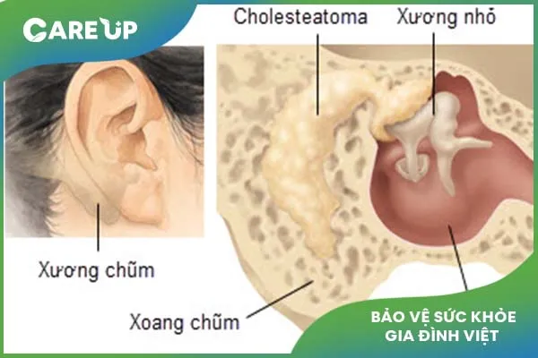 Bệnh viêm tai xương chũm ở trẻ em có nguy hiểm không?