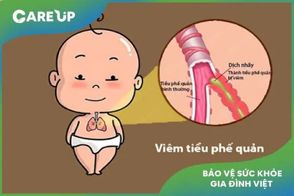 Cách chữa bệnh viêm tiểu phế quản ở trẻ em phụ huynh nên biết