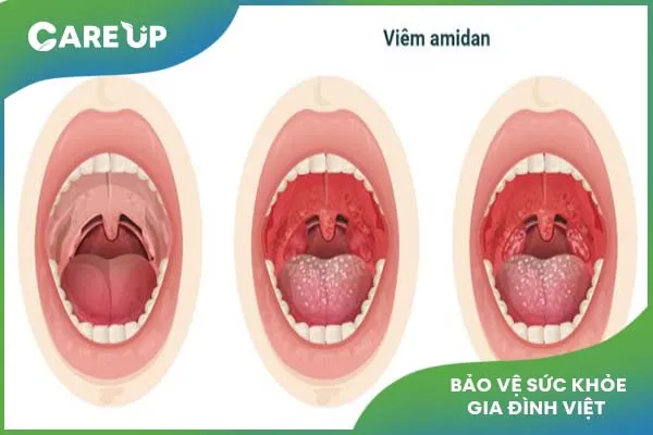 Chữa viêm Amidan cho trẻ: Tổng hợp phương pháp