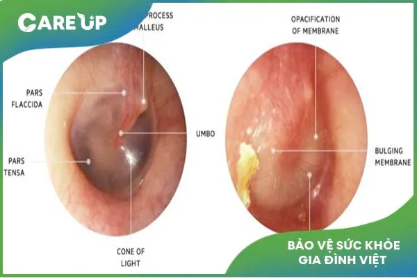 Chữa viêm tai giữa cho trẻ: Những điều bố mẹ phải biết