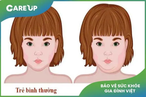 Chuyên gia giải đáp: Quai bị có lây không?