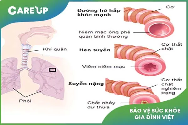 Điều trị hen ở trẻ em và những điều chưa biết