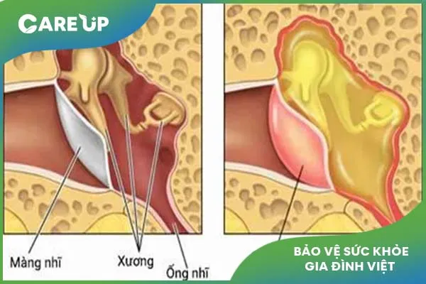 Giải đáp: Bệnh viêm tai giữa thanh dịch ở trẻ nhỏ