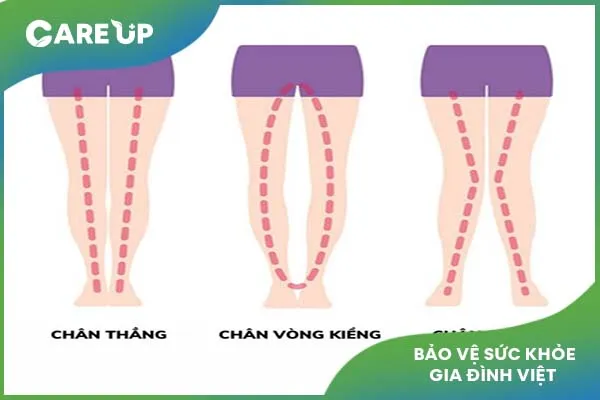 Giải đáp: Vì sao thiếu Vitamin D trẻ bị còi xương?