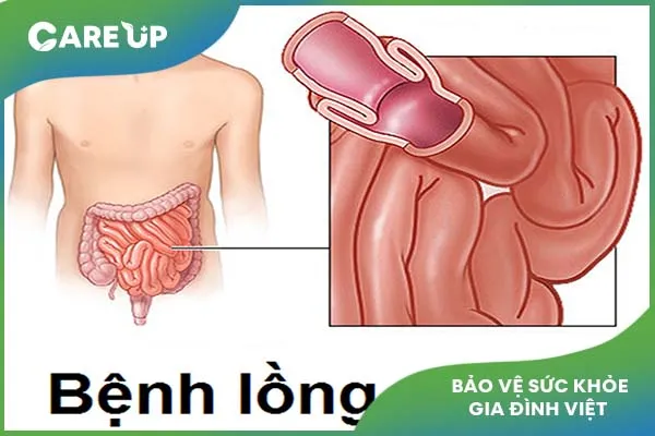 Nguyên nhân và cách điều trị hiệu quả khi bé bị lồng ruột