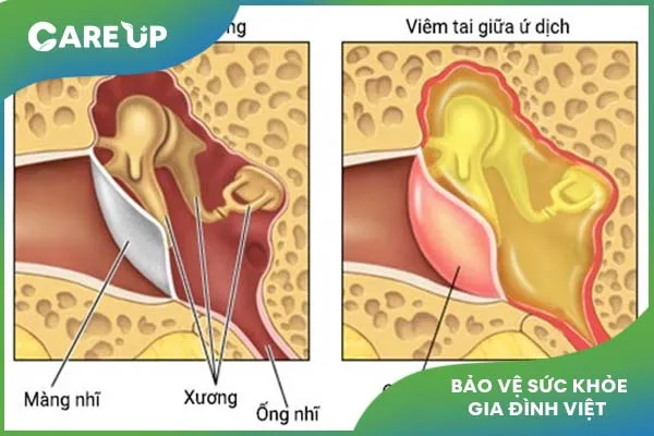 Những điều cần biết về bệnh viêm tai giữa tiết dịch ở trẻ