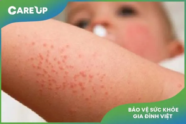 Những điều cần lưu ý về bệnh herpes ở trẻ em