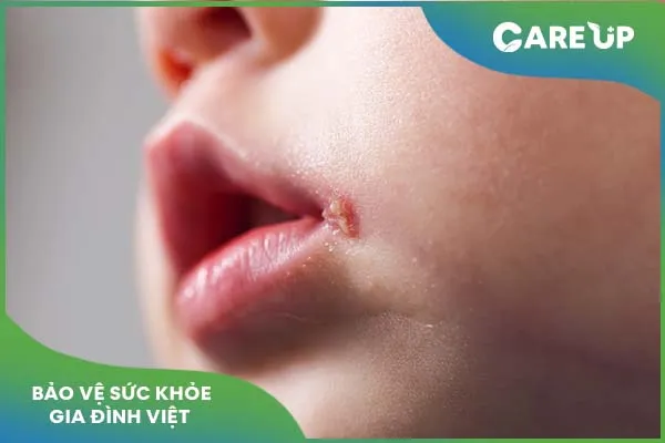 Những điều cần lưu ý về bệnh herpes ở trẻ em