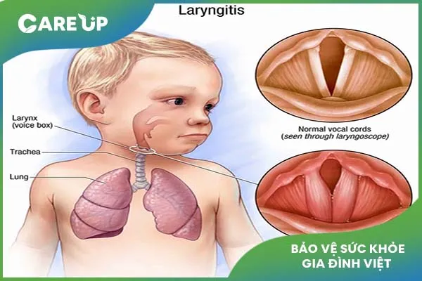 Trẻ bị viêm thanh quản: Cách điều trị và chăm sóc trẻ tại nhà