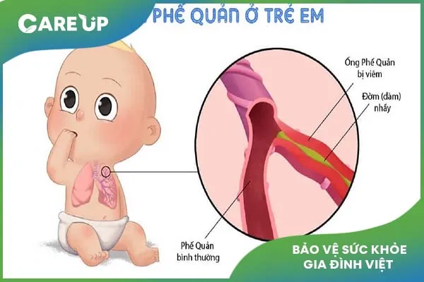 Viêm phế quản ở trẻ: Cảnh giác nguyên nhân, điều trị đúng cách