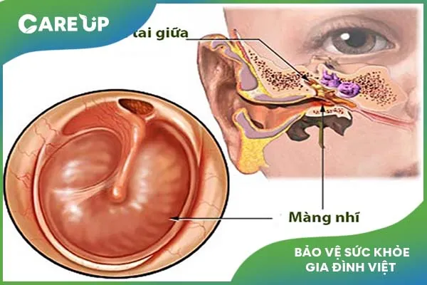 Viêm tai giữa mạn tính có nguy hiểm cho trẻ không?