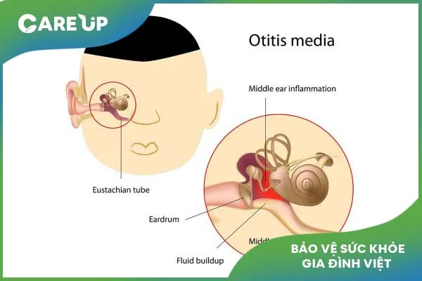 Viêm tai giữa ở trẻ em: Nguyên nhân, dấu hiệu, cách điều trị